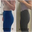 유라인의원 후기 : 복부지방분해주사 3회차 받았어요!