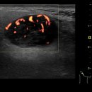 pleomorphic adenoma or warthin's tumor,parotid gland 이미지