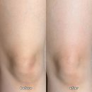 주바뷰티샵 | 청주 웨딩케어 비유티풀 고주파 바본 하체관리 1회 후기