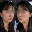 울쎄라 리프팅 가격 및 효과 후기 공유(+튠페이스)
