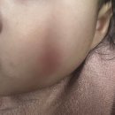 리멤버피부과 - 파주시 교하로 87 | [밀크반점 치료] 리멤버피부과 16회~20회차 치료 후기