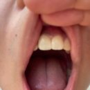 군자 송정동치과 앞니 레진 크라운 치료 후기 2