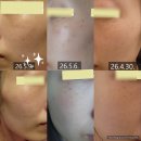 [서면피부과내돈내산]주근깨잡티제거레이저 헬리오스4_피부과(?)한의원 내돈내산후기