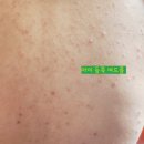 함익병피부과의원 | 한티역 함익병 피부과 4번째 진료 후기 사춘기 아이 여드름 치료