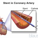 관상동맥질환(Coronary Artery Disease) 개요