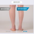 코어핏 | 쿠도쉐입 코어핏 풋아치 패드로 체형교정 후기