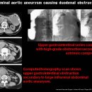 Abdominal aortic aneurysm causing duodenal obstruction 이미지