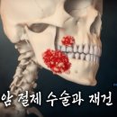 구강암 절제 수술 ㄷㄷ 이미지