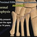 발가락 골절 - 제5중족골 기저부 골절 이미지