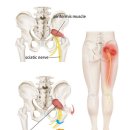 ​좌골신경통처럼 느껴지는 이상근 증후군 이미지