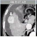 간암의 치료방법 과 부작용 이미지