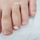킴스케어시스템 | 20대 취준생 무좀발톱 완벽개선, 광주 충장로 킴스네일 발톱관리 후기