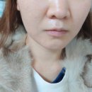 샤인빔의원 | 분당 샤인빔의원에서 윤곽주사 맞은 솔직 후기