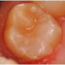 필치과기공소 | 양구치과, 충치 레진 치료는 '이것'때문에 실패한다? [의사 조언]