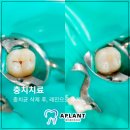 에이플란트치과의원 네이버블로그