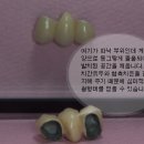 오베이트 폰틱 ( Ovate Pontic) 이미지
