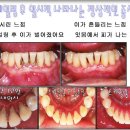 예플란트치과 네이버블로그
