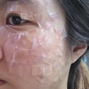 [부산/서면] 후한의원 부산점, 편평사마귀 제거부터...내돈내산 솔직 후기ㅣ제거 시 통증 | 관리방법ㅣ요금