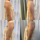 미메디 | 광주 에스테틱 수완지구 <365메디스킨> 극초단파 미레브 팔뚝관리 후기 | 웨딩관리, 광주여드름관리...