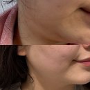 올의원 | 명동역피부과 올의원 온다리프팅 솔직후기