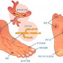 당뇨발 초기증상 치료 당뇨 발가락 관리 방법 이미지