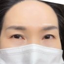 (주)디자인파란 | 반영구화장 잔흔으로 보기 싫은 파란, 검은 중년눈썹눈썹지움 직후 후기