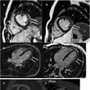 mRNA 백신 접종 후 심근염이 있는 청소년 코호트에서 영구적 심장 자기 공명 영상(MRI) 소견 이미지