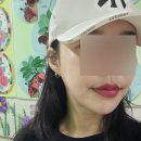 동래피부과 쿨페이즈리프팅 효과 통증 후기