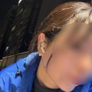 타이트짐 | 청담동 피부과 올타이트리프팅 400샷 솔직 후기