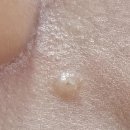 박달나무한의원 | [전주] 피침 요법으로 점을 뽑아버리기 내돈내산 전주 박달나무 한의원