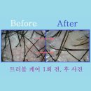 두피 탈모 아미치 0.3 수원점 이미지