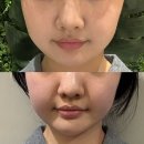 울산베스트피부과의원 | 울산 리프팅 티타늄레이저 삼산피부과 내돈내산 후기