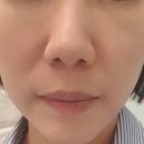 다올린의원 | 포텐자 다이아몬드 리프팅 후기