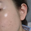 약초 | 천안 피부관리 퓨어르떼 약초필 찐 경과후기