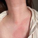 진*애 | 알러지약 삼켜도 또 올라오던 두드러기 잠잠해진 후기