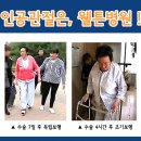 무릎인공관절 수술 후 재활치료는 어디병원이 잘 할까요~ 이미지