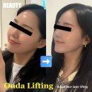 한국한의원 | 부산 서면한의원 온다리프팅 LDM 경옥고 이중턱 타이트닝 후기 효과