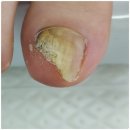 주안말 | 인천 주안 간석동 발톱무좀 파고드는발톱 복한관리 대만족 에이풋케어