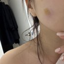 해주여관 | 보조개 시술 후기- 부작용, 염증 치료, 마취