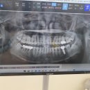 민들레치과의원 | 병원일지:) 사랑니 발치 수원 퍼스트 사랑니 치과 #사랑니맛집 #수원치과