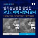 현신경과의원 | 완전 매복사랑니 발치 + 함치성낭종 제거 복합 수술 후기
