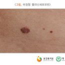 815. 멜라닌세포모반 melanocytic nevus 이미지