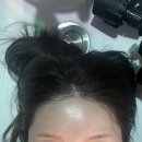 장수케어 | 수원탈모케어 이씨바버샵 정수리 모백생장술 후기