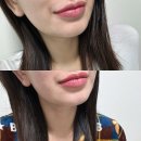 상남로-1 | 창원 바노바기 리프팅 레이저 리프테라2 효과 가격 펜타입 5000샷 후기 가성비 좋아요