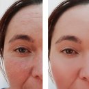 비포애프성형외과의원 | 하안검 주름 재형성 눈밑 구조를 다시 정돈해 자연스럽게 회복