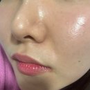 청춘의원 | [환공포증주의]밴스의원 충주점 스킨보톡스 후기 feat.아프니까 청춘이다, 찐후기, 1주차 2주차까지?