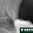 범플란트치과의원 네이버블로그