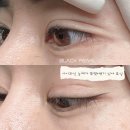아이미인 | 또렷한 눈매와 매력포인트를 완성하는 대전아이라인 미인점 시술 후기