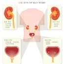 소변이상 이미지