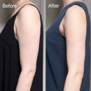 주식회사 다온다옴 | 압구정피부과 온다리프팅 볼릿주사 후기 팔뚝살 2주차 전후비교